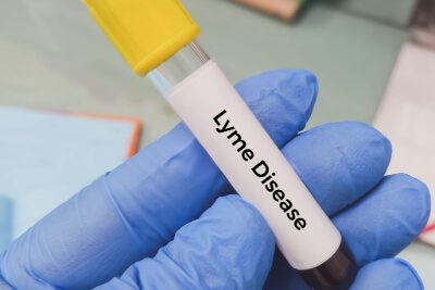 Vile of blood that tested positive for Lyme Disease
